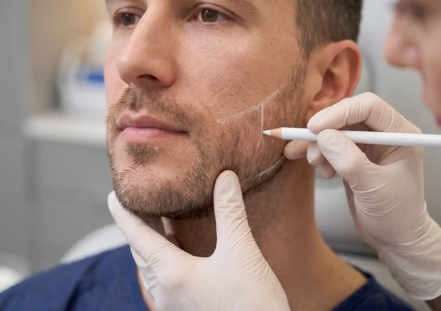 A close-up of a male patient having his jawline and cheek marked with a white pencil by a gloved practitioner during a facial anatomy consultation for botox for men Bali