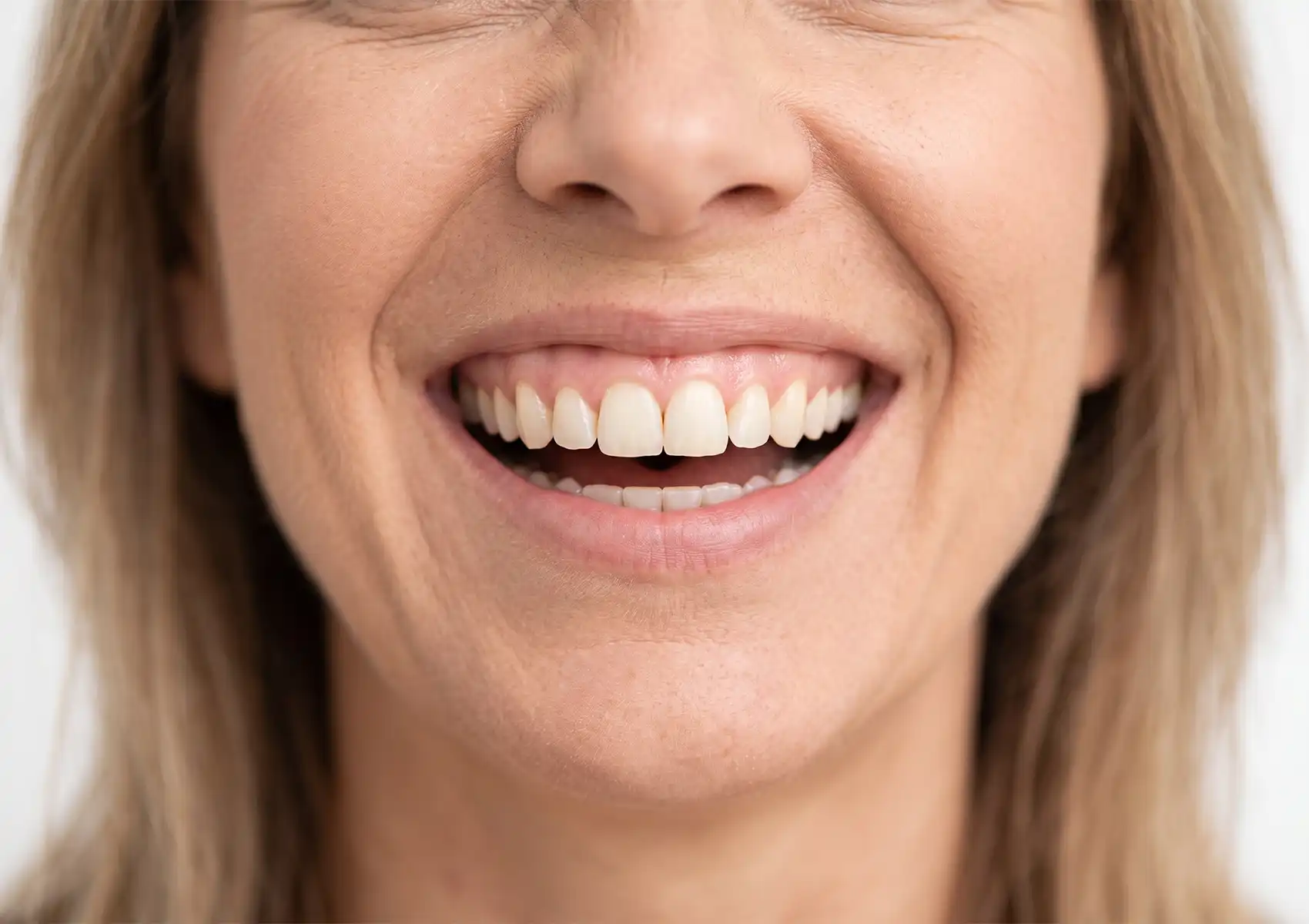 A close-up of a woman smiling broadly and showing her upper gumline, illustrating the typical 'before' condition of a patient seeking a gummy smile treatment.