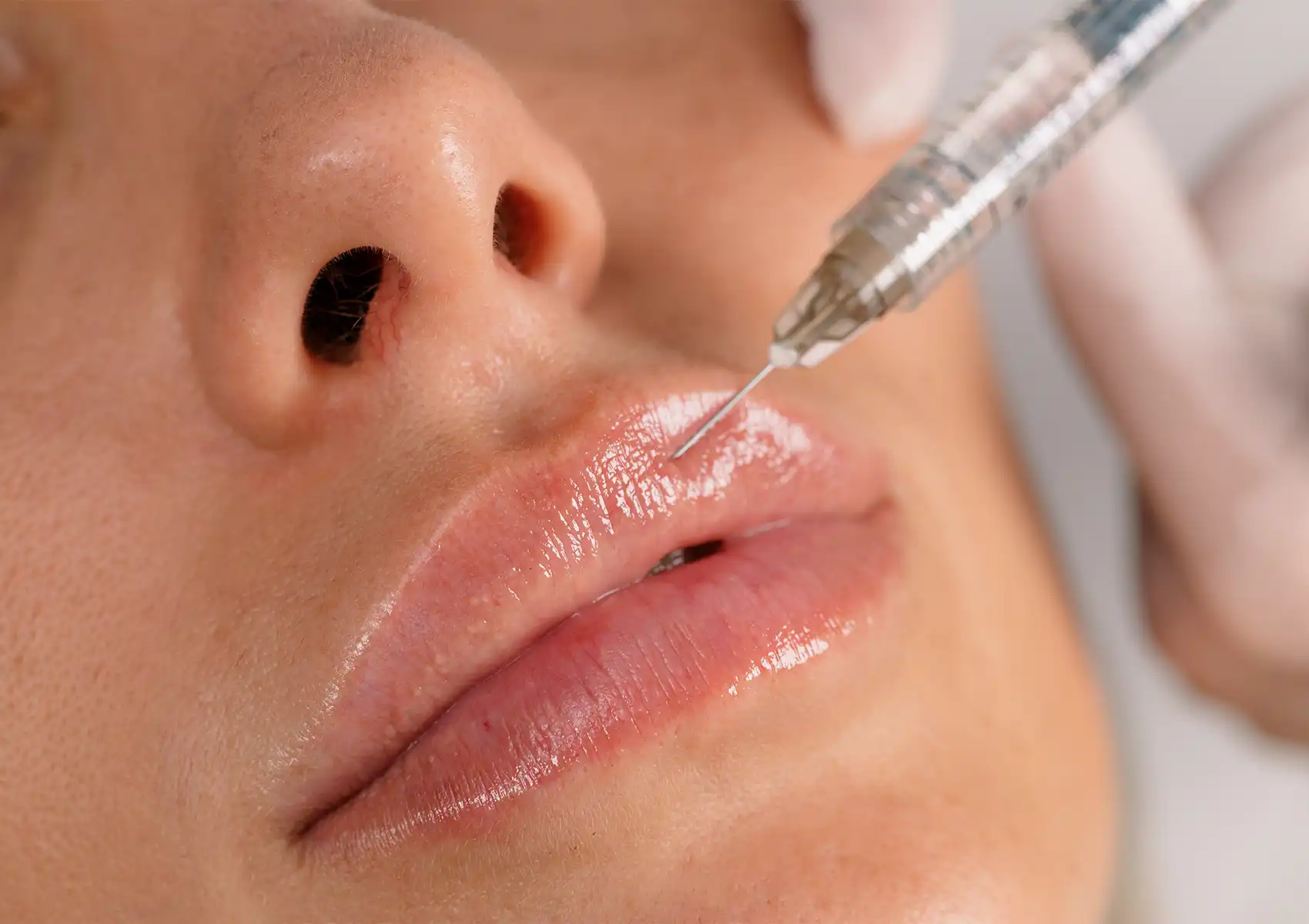 A close-up view of a fine syringe needle precisely injecting a patient's upper lip, demonstrating the technique used to relax the muscle during a lip flip Bali.