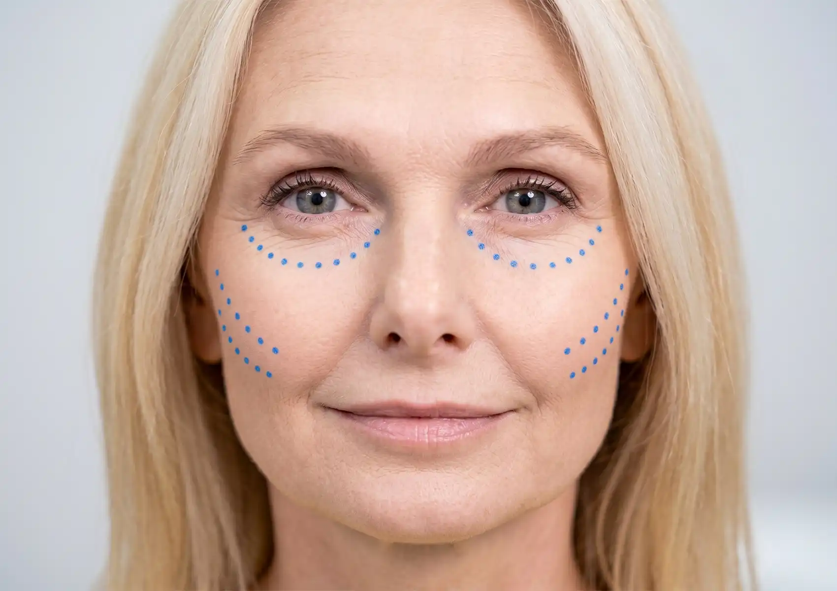 A close-up portrait of a mature blonde woman with blue dots mapping out targeted injection sites along her cheeks and under her eyes, preparing for a cosmetic procedure at a doctor-led aesthetic clinic Bali.