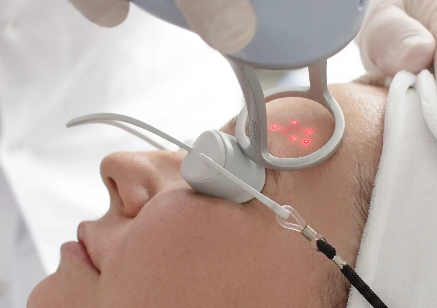 A close-up of a patient wearing protective eye shields undergoing a skin rejuvenation treatment on her forehead with a laser handpiece emitting red target beams, highlighting skin resurfacing options like Lavieen vs pico laser.