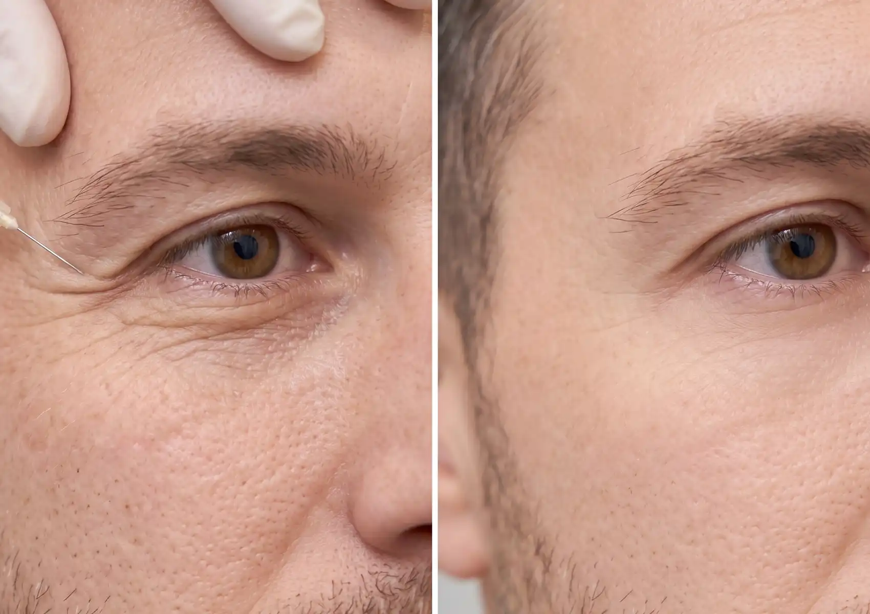A split-screen before and after comparison demonstrating the results of botox for men Bali, showing a man's eye with crow's feet and an injection needle on the left side, and visibly smoother skin around the eye on the right.
