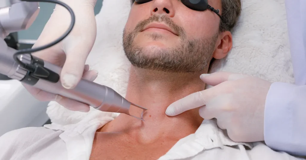 Pico Laser Treatment by Anaya Aesthetics