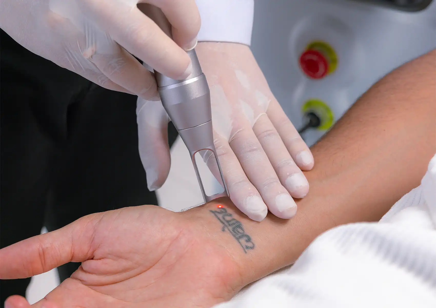 A close-up shot showing a practitioner's gloved hands using a Pico laser to precisely target and break down ink on a patient's wrist tattoo at a beauty clinic bali.